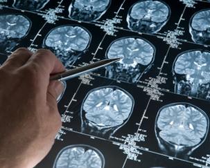 Speranțe pentru cei peste 10.000 de maramureșeni care suferă de epilepsie