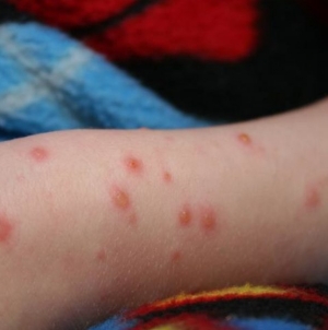 Epidemie de rujeolă în țară, declarată de Ministerul Sănătății. Care este situația în Maramureș
