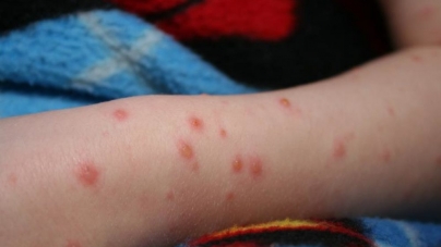 Epidemie de rujeolă în țară, declarată de Ministerul Sănătății. Care este situația în Maramureș