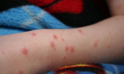 Cele mai multe cazuri de rujeolă s-au înregistrat, de la începutul epidemiei, la copiii nevaccinaţi