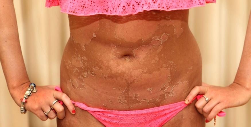 Expunerea excesivă la soare poate provoca și arsuri de gradul II