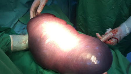 O splină de 6,5 kg, înlăturată  de medicii băimăreni printr-o operație complexă care a durat două ore