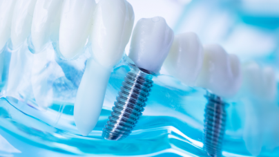 De ce să alegi implanturile dentare?