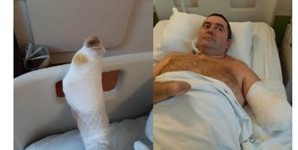 Un bărbat din Lăpușel are nevoie de ajutor după ce și-a pierdut mâna dreaptă, antebrațul și o parte din piciorul stâng într-un accident