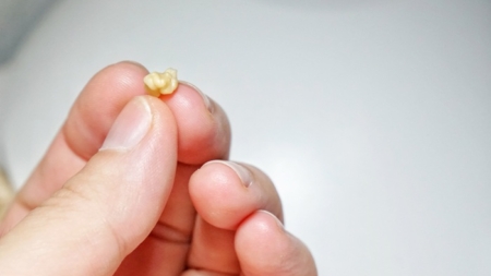 De ce apar pietrele pe amigdale și cum le poți preveni