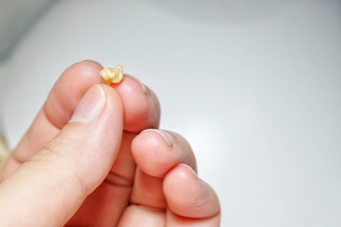 De ce apar pietrele pe amigdale și cum le poți preveni