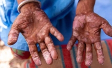 Alertă sanitară în Cluj – un caz de lepră confirmat, trei sub monitorizare