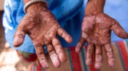 Alertă sanitară în Cluj – un caz de lepră confirmat, trei sub monitorizare