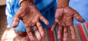 Alertă sanitară în Cluj – un caz de lepră confirmat, trei sub monitorizare