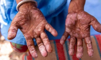 Alertă sanitară în Cluj – un caz de lepră confirmat, trei sub monitorizare