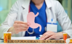 Ce sunt varicele esofagiene și cum le recunoști?