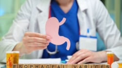 Ce sunt varicele esofagiene și cum le recunoști?