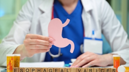 Ce sunt varicele esofagiene și cum le recunoști?