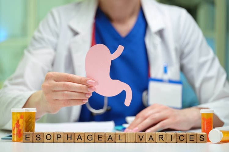 Ce sunt varicele esofagiene și cum le recunoști?