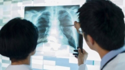 24 martie, Ziua Mondială de luptă împotriva Tuberculozei