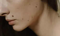 Papilom sau aluniță? Cum îl recunoști și când mergi la dermatolog?