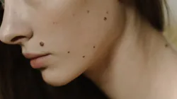 Papilom sau aluniță? Cum îl recunoști și când mergi la dermatolog?