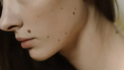 Papilom sau aluniță? Cum îl recunoști și când mergi la dermatolog?