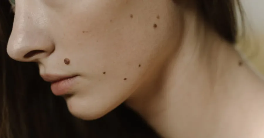 Papilom sau aluniță? Cum îl recunoști și când mergi la dermatolog?